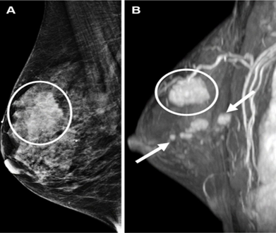 FMRI Revealed Additional Breast Tumors Not Visible on Mammography — The Primary Tumor Is Circled, While Additional Lesions Detected by MRI Are Marked with Arrows